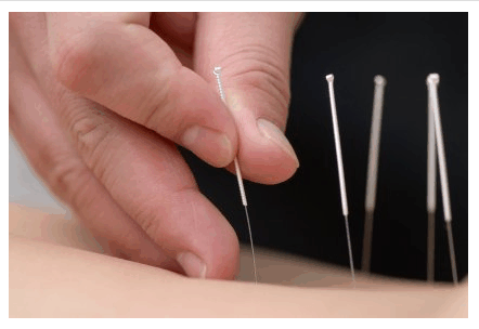 L'Acupuncture