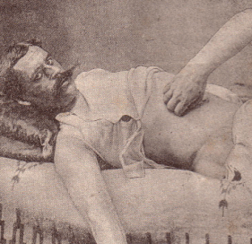 Krammgriff, Le massage par George Berne en 1894